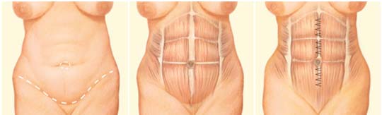 Abdominoplasty Surgery, Abdominoplasty Surgery India, Cost Abdominoplasty, Abdomen, Tummy
